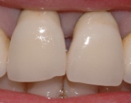 protesi fissa estetica dentale prima